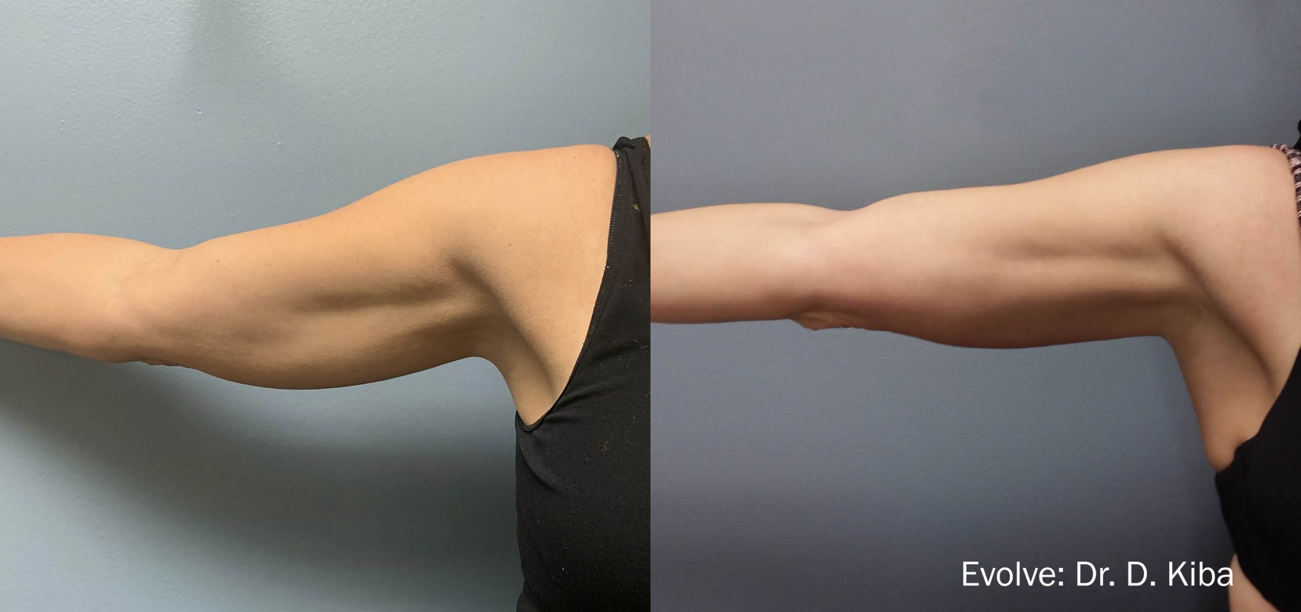 Body Contouring Of Arms