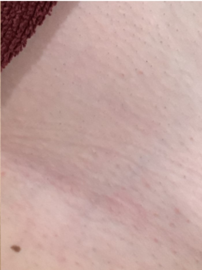 Laser Hair Removal Under The Armpit Of A Female, After