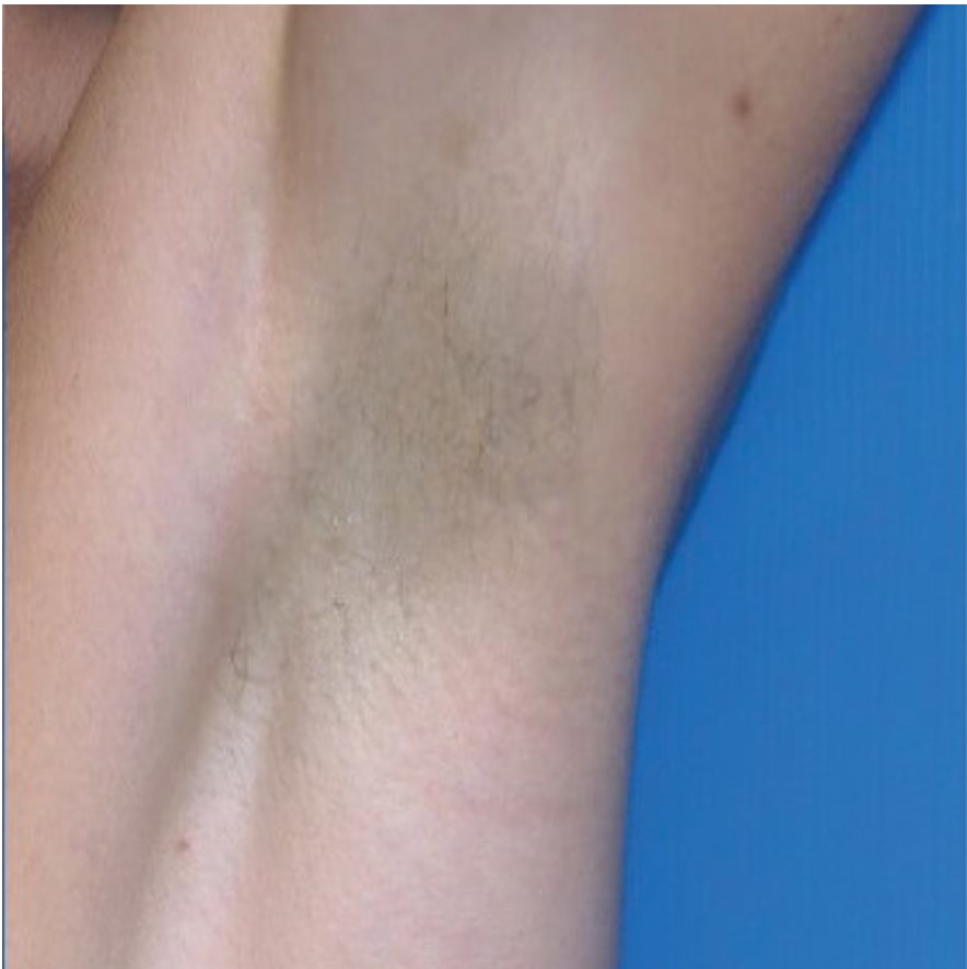 Laser Hair Removal Under The Armpit Of A Female, After 