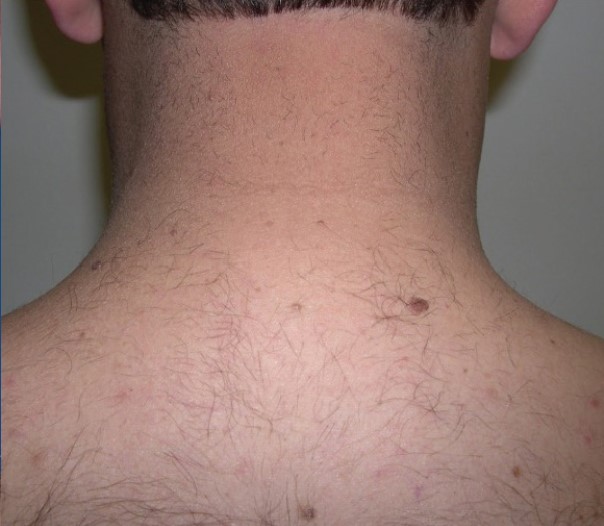 Laser Hair Removal On The Back Of The Neck Of A Male, After