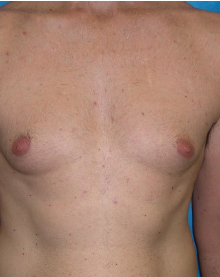 Laser Hair Removal On The Chest Of A Male, After