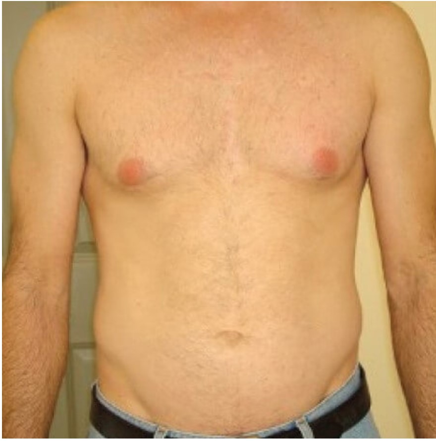 Laser Hair Removal On The Chest Of A Male, After