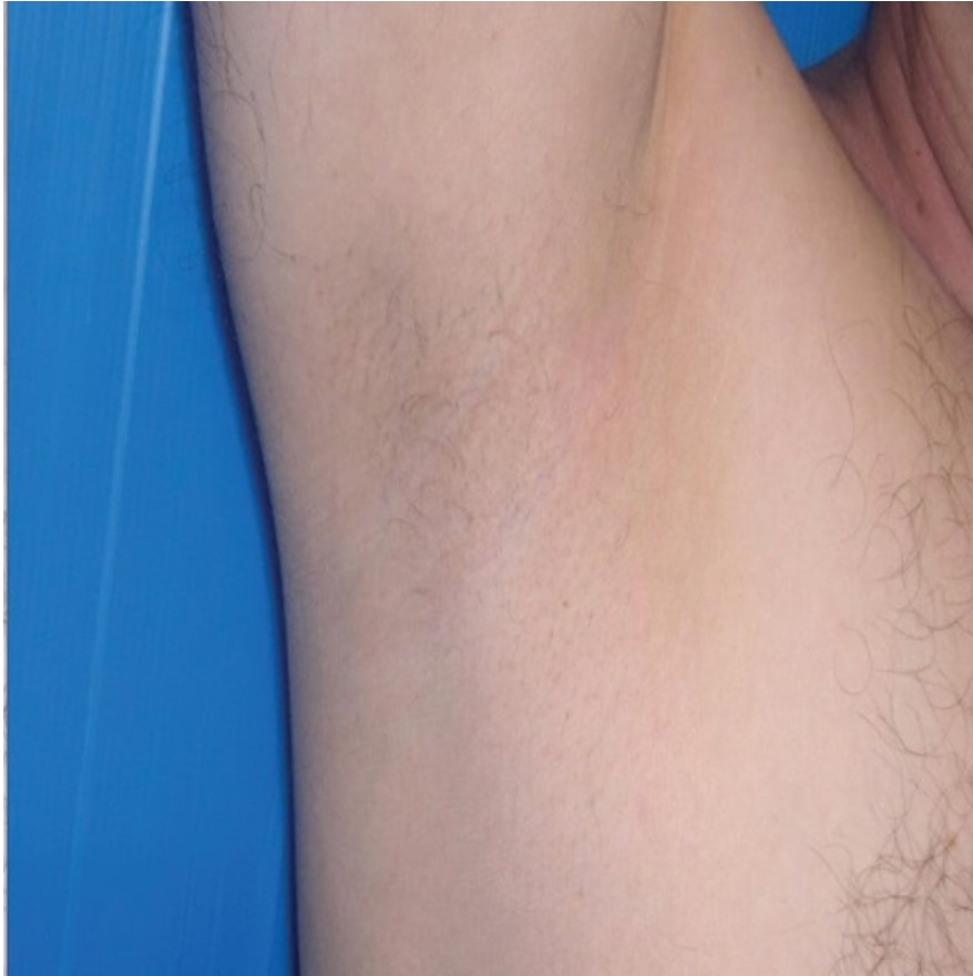 Laser Hair Removal Under The Armpit Of A Male, After