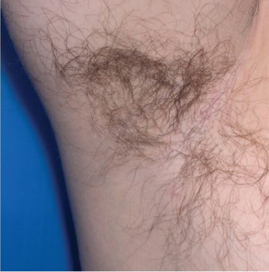 Laser Hair Removal Under The Armpit Of A Male, Before