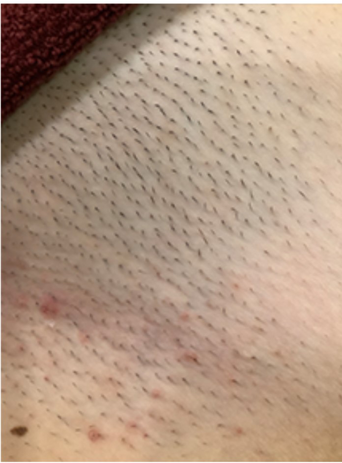 Laser Hair Removal Under The Armpit Of A Female, Before