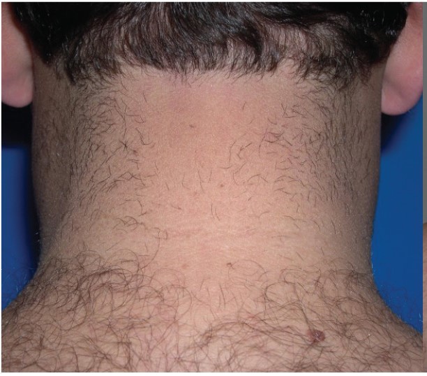 Laser Hair Removal On The Back Of The Neck Of A Male, Before