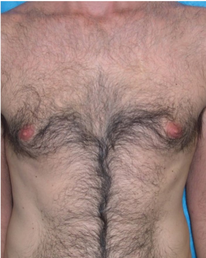 Laser Hair Removal On The Chest Of A Male, Before