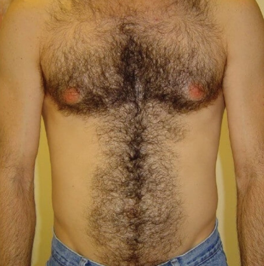 Laser Hair Removal On The Chest Of A Male, Before
