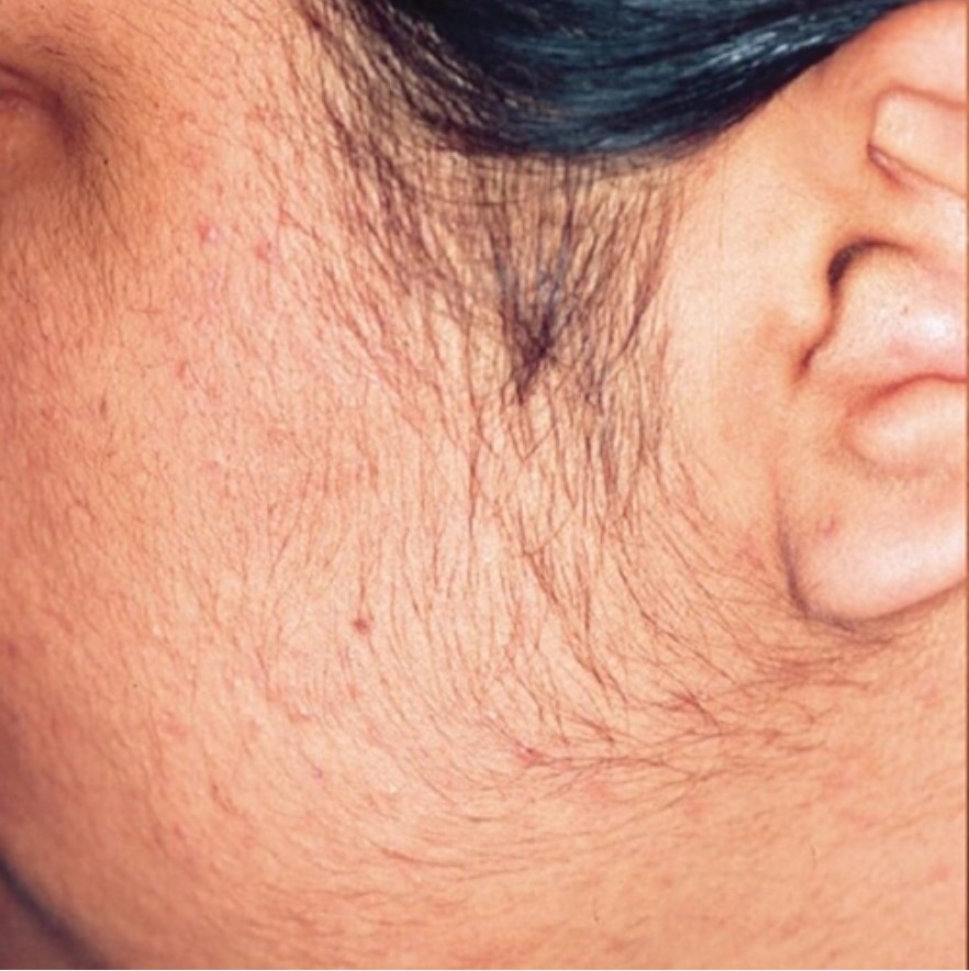 Laser Hair Removal Of The Sideburns Of A Female, Before