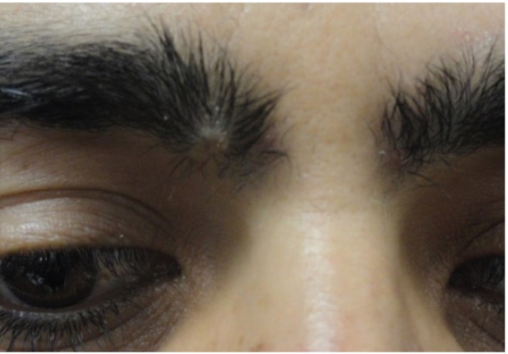 Laser Hair Removal Of The Glabella Of A Female, Before