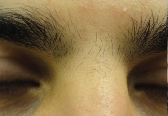 Laser Hair Removal Of The Glabella of A Female, After