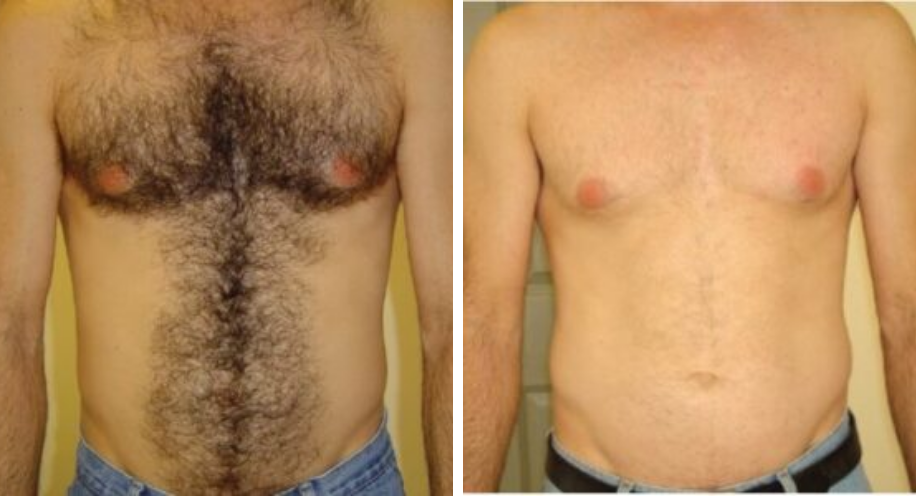 DrAngelAlexander-ProHealthServices-LaserHairRemoval1-April2026