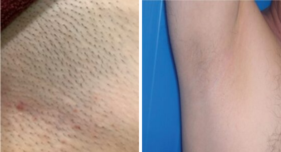 DrAngelAlexander-ProHealthServices-LaserHairRemoval2-April2026