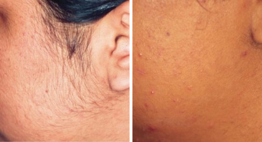 DrAngelAlexander-ProHealthServices-LaserHairRemoval3-April2026
