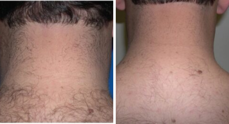 DrAngelAlexander-ProHealthServices-LaserHairRemoval4-April2026